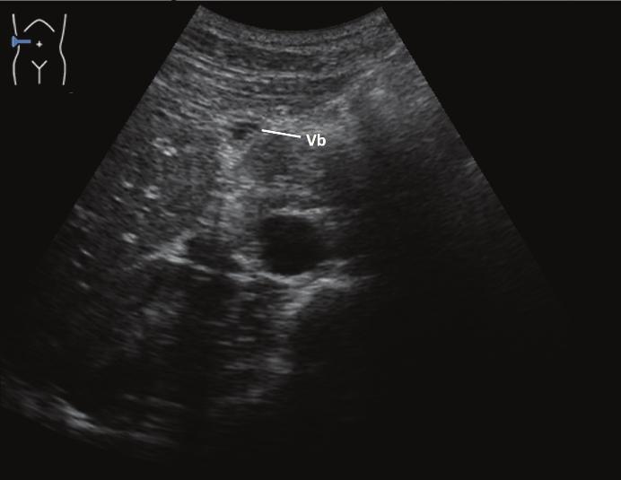 Abbildung 30: Entleerte Gallenblase (Vesica biliaris, Vb) mit verdickter Schleimhaut, sagittal und transversal.