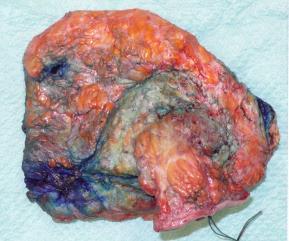 associated intestinal anastomosis. Blue-ectomy the tissues, in place.