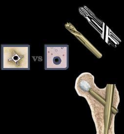 Intramedulläre Osteosynthese Schrauben oder Klingensysteme als Schenkelhalsimplantat