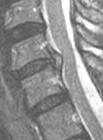 Nervenwurzel Zervikoradikuläres Syndrom MRI HWS In den Schrägaufnahmen Beurteilung der Foramina und Korrelation zu DH / deg.