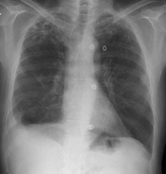 Pulmonale TB Primärtuberkulose - Infiltrat + Lymphknotenvergrößerung Postprimärtuberkulose -