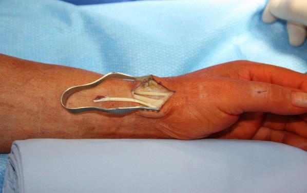 Bei beiden Operationen wurde eine Oberarmblutleeremanschette angebracht und diese nach Auswickeln des Armes mit der Esmarchbinde bei 350 mmhg geschlossen.