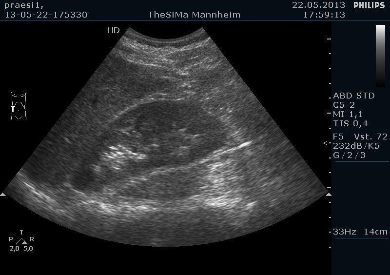 Schnitte Schnitt 1: Leber und rechte Niere Der Schallkopf wird im Längsschnitt auf der rechten Flanke in der mittleren Axillarlinie