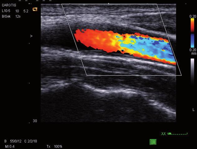 Schwarzkopf Modul 2 Gefäßsonographie 13:45-14:15 Gefäßkanülierung/Ultraschallgesteuerte Punktion venöser Gefäße US-gesteuerte Punktion arterieller Gefäße 14:15-14.:45 Thromben-Detektion /Venen-Kompr.