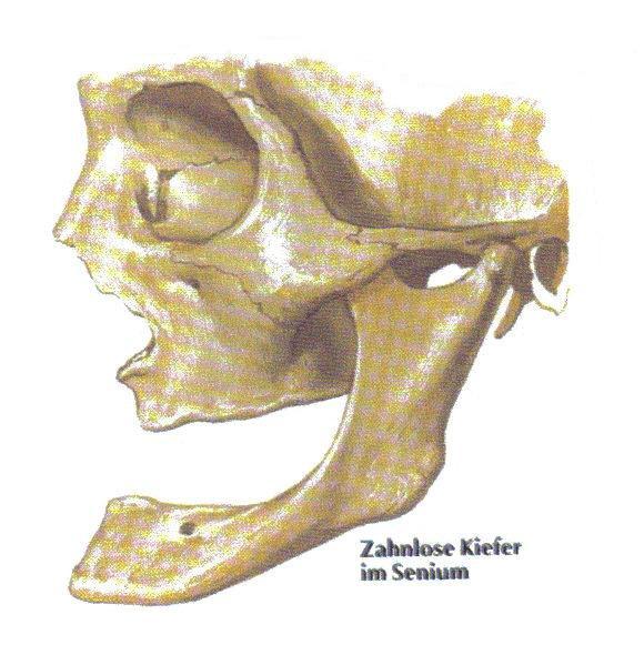 Beim zahnlosen Greisenkiefer mit rückgebildeter Pars alveolaris liegt es nahe dem Oberrand. Abbildung.4 Zahnlose Kiefer im Senium ( Quelle: Netter) Unter dem Foramen mentale beginnt die Linea obliqua.