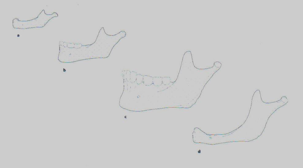 Abbildung.5 Altersabhängige Veränderungen der Mandibula ( Quelle: Prometheus) a. Neugeborenenalter: Mandibula ohne Zähne, Pars alveolaris noch nicht angelegt. b.