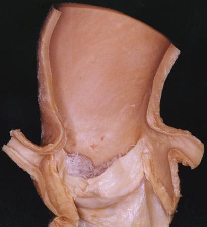Valva aortae Valvula semilunaris dextra