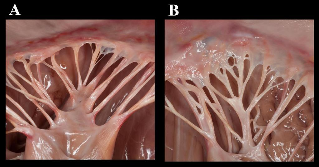 Kommissuren der Mitralklappe Cuspis