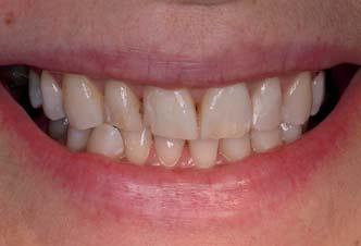 36) Diese neue und innovative Annäherung ans Thema des laserunterstützten Aufhellens der Zähne hat uns eine wertvolle Bereicherung in der Kategorie der minimalinvasiven Therapien für den Praxisalltag
