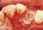 STARKE ATROPHIE IM UNTERKIEFER Eine der größten Herausforderungen in der oralen Implantologie ist die vertikale Augmentation des stark atrophierten Unterkiefers.