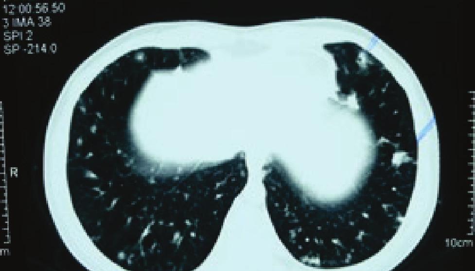 Die rechte Aufnahme wurde zwei Jahre später angefertigt und zeigt nun erhebliche, krankhafte Veränderungen (weißlich) auch innerhalb des (eigentlich ansonsten schwarzen) Lungengewebes.