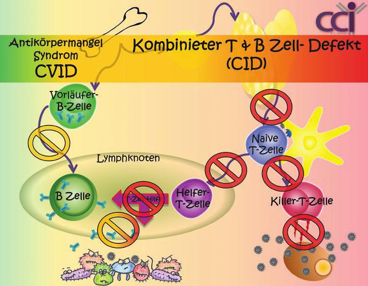 Abbildung 3: CVID vs. CID: Fließender Übergang und daher eine diagnostische Herausforderung.