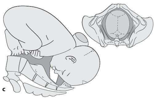 Die Pfeilnaht ist ausrotiert (Abb. c). 4. Streckung: Der Kopf muss die Krümmung im Geburtskanal passieren und wird dazu retroflektiert.