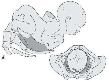 Zweite Rotation und Schultergeburt. Bei der Geburt des Kopfes steht die Schulterbreite in Übereinstimmung mit dem querovalen Beckeneingang.