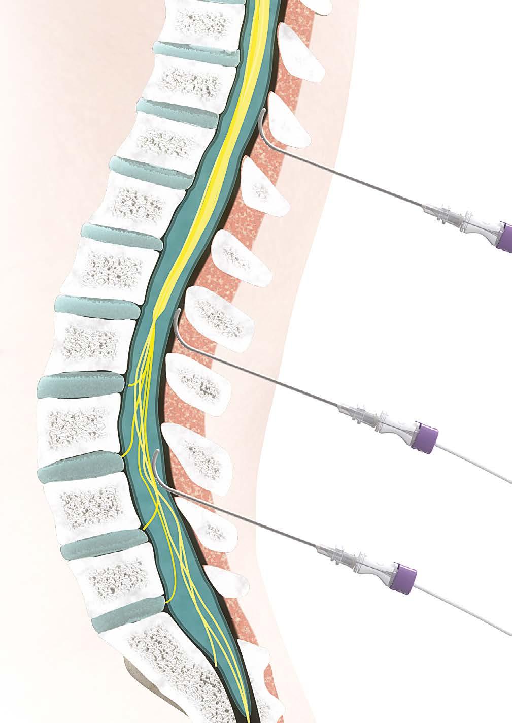 Patient: 2/6 Spinalanästhesie (SPA) Dieses Verfahren eignet sich zur Betäubung der Nerven, die vom Rückenmark zum Eingriffsgebiet führen.