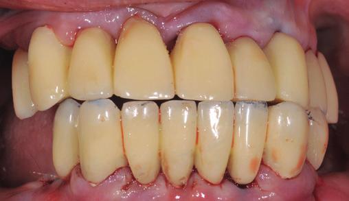 Abb. 1: Die klinische Situation zeigt die verkürzte Zahnreihe im Ober- und Unterkiefer. Abb.