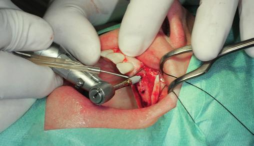 Abb. 14: Insertion eines Implantats. Abb. 15: Vier Implantate in gewünschter Position. Abb. 17: OPG nach Implantation.