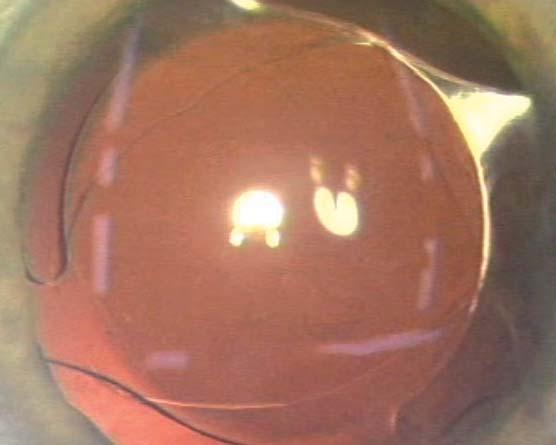 Akreos Adapt: Für vollendete postoperative Ergebnisse ohne Nachstar In einer Studie mit 632 Augen (3) war nur bei einem Auge (0,15%) eine Nd:YAG-Laser-Kapsulotomie erforderlich.