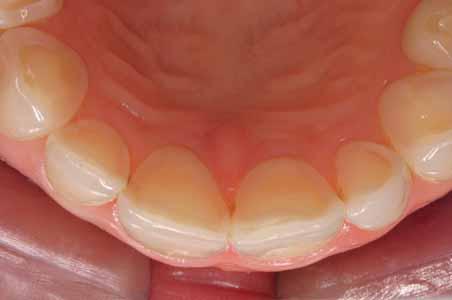Abbildung 1 Durch häufiges Erbrechen induzierte intrinsische Erosionen der palatinalen und okklusalen Zahnoberflächen.