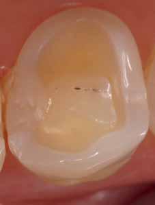 Einleitung Dentale Erosionen stellen einen chemisch induzierten irreversiblen Zahnhartsubstanzverlust durch exogen oder endogen zugeführte Säuren dar, der sich zunächst oberflächlich im Schmelz