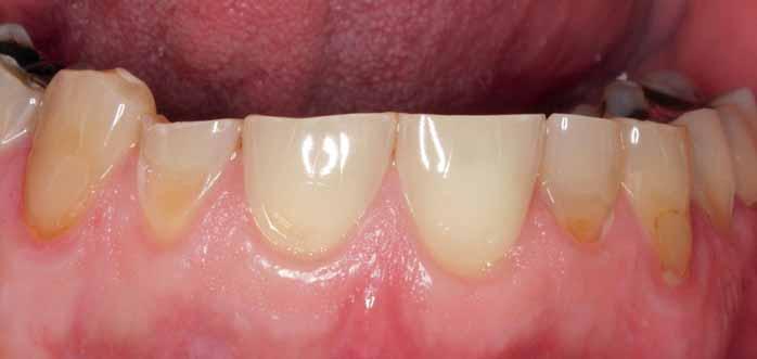 Abbildung Extrinsische Erosionen der labialen Zahnoberflächen durch hochfrequenten Konsum von Softdrinks.