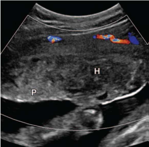 Radiologische Diagnostik Klinische Indikation unabhängig von Sorge um Fetus Sono: FAST (Sensitivität und Spezifität