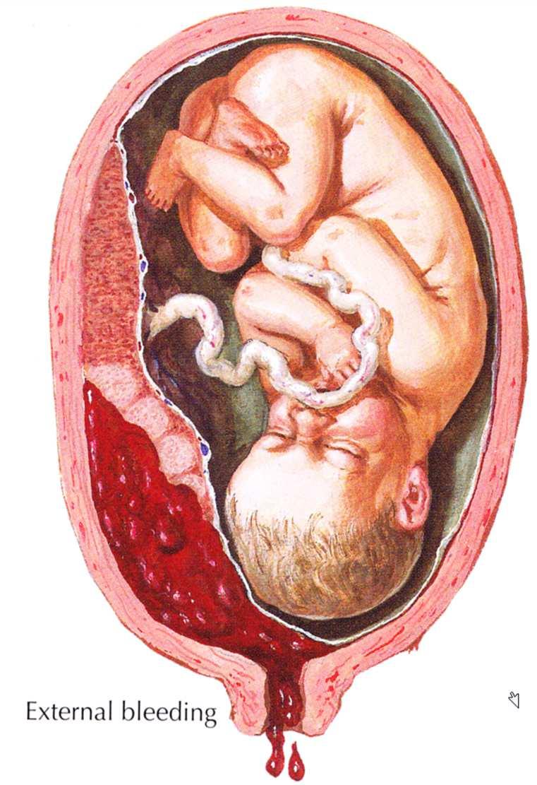 Prognose schwangere Traumapatientin Unabhängige Prädiktoren für fetales Outcome fehlen Faktoren für maternale Morbidität und Mortalität: Injury Severity