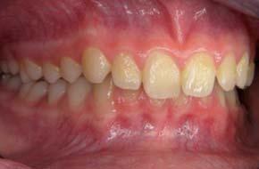 sttistish signifiknten Un ter - shieden zwishen proklinierten und niht proklinierten Shneide - zähnen gering und die d rus resultierende