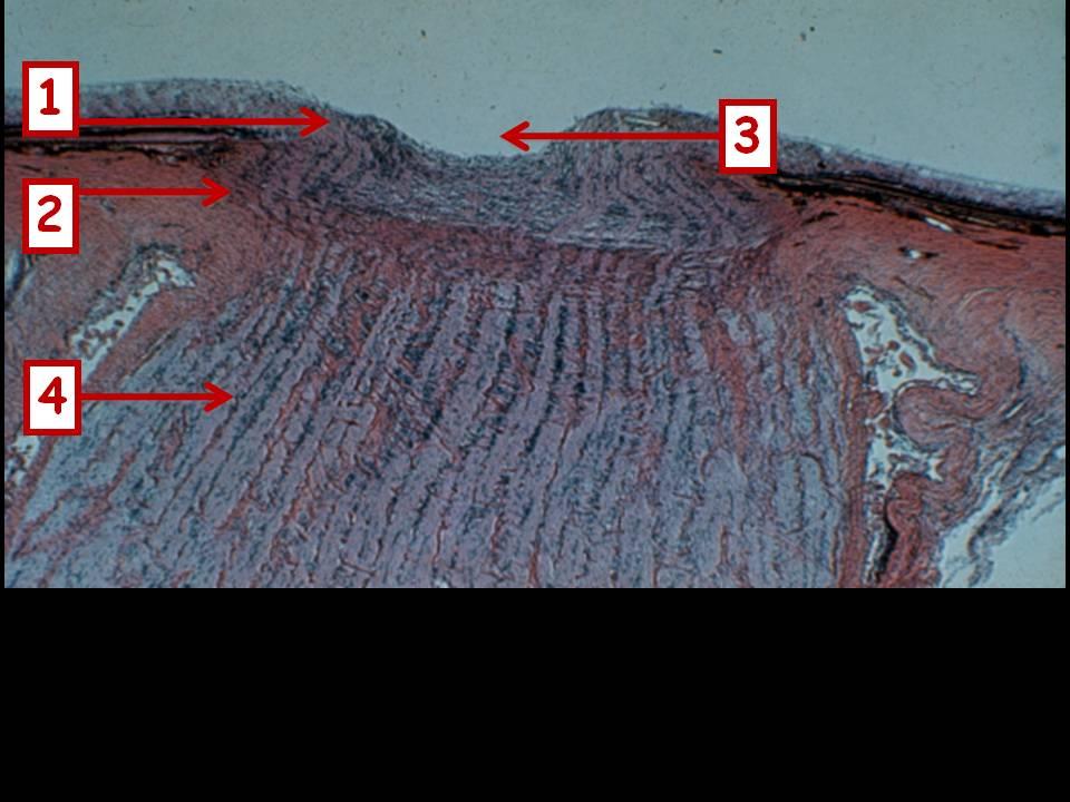 Man gibt Ihnen die histologischen Präparate von 2 Sehnerven mit Papille. Der Patient 1 (Bild 1) gibt an seit dem 65. Lebensjahr etwas verschwommen gesehen zu haben.