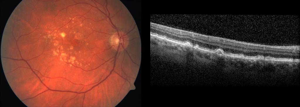 Stoffwechselprodukten unterhalb des retinalen Pigmentepithels. Diese Abbauprodukte werden im Normalfall vom Retinapigmentepithel aufgenommen und abgebaut.