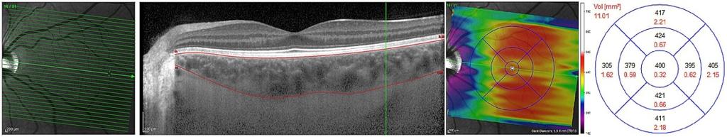 Abbildung 12: Messung des Aderhautvolumens Abbildung 13: Raster zur Segmentierung des Aderhautvolumens Scan von einem linken Auge eines 80-jährigen männlichen Patienten dieser Studie Baseline