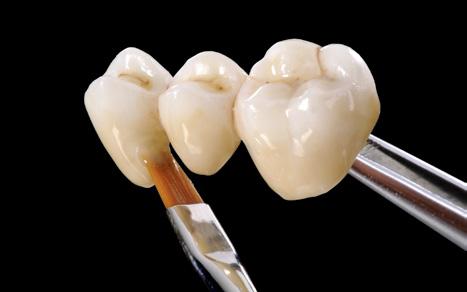 13 Chromaverstärkung des Zahnhalses b.