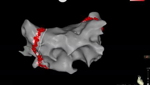 Ablation von Vorhofflimmern Entwicklung