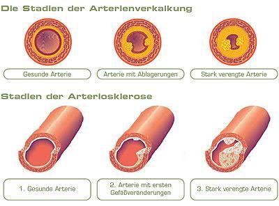 Herz: Herzinfarkt, Koronare Herzerkrankung