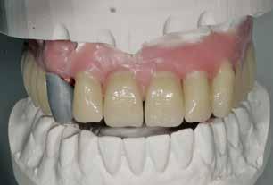 Die individualisierten Inzisalkanten fügen sich harmonisch in die Gesamtsituation ein, der Zahnbogen kann als ideal bezeichnet werden (Abb. 43).