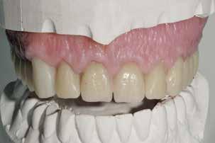 Zudem sind geeignete mechanische Retentionen in die Zähne einzuschleifen, falls noch nicht geschehen.