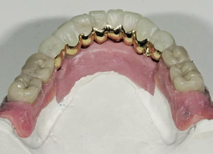 Mit Gegenbiss zeigt sich ein ansprechendes Ergebnis, die Zahnbreiten der Frontzähne im Oberkiefer und Unterkiefer