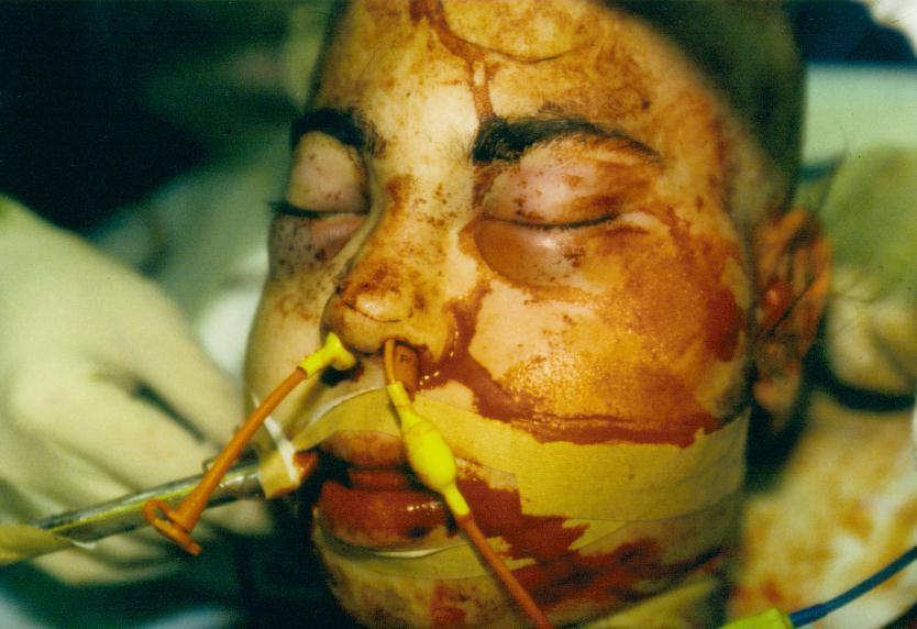 Risikofaktor Offene -, und Gesichtschädelfrakturen Eine offene Schädelfraktur führt zu