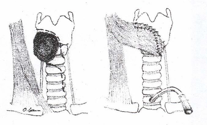Bei unilateralem Tumorbefall mit Infiltration von mehr als zwei Zentimeter longitudinal des Larynx sowie mehr als einem Viertel der Zirkumferenz erfolgt eine zirkuläre Segmentresektion und