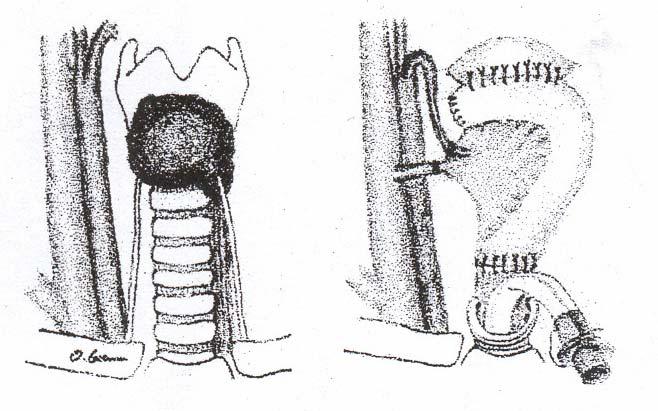 Bei bilateraler Tumorinfiltration des Larynx mit mehr als cm longitudinal und mehr als einem Viertel der Zirkumferenz ohne Infiltration des Ösophagus ist die Entfernung des Larynx die einzige kurativ