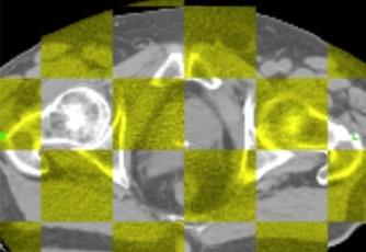 Während die TomoHD mit der helikalen IMRT arbeitet, die zusammen mit der integrierten Low-dose-CT den Tumor vor jeder Behandlung sichtbar macht und seine Lokalisation neu bestimmt (IGRT), ist die