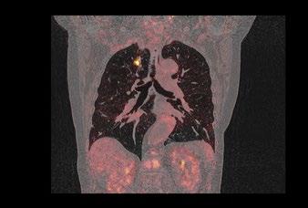 C FRAGESTELLUNGEN IN DEN FACHBEREICHEN Aktuelles Fallbeispiel: Lungenmetastase eines Bronchialkarzinoms Anamnese 75-jährige Patientin mit einem