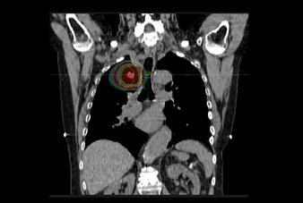 Befund In der FDG-PET/CT findet sich eine solitäre Lungemetastase im Oberlappen rechts apikal.