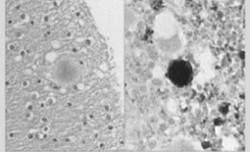 biochemischen Eigenschaften des abnormen Prionproteins (PrPSc Typ 1 oder 2, unterschiedlich nach Größe, gemessen an der Wanderungsgeschwindigkeit der unglykosylierten PrP-Bande im Immunoblot) (Parchi