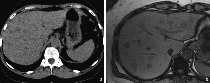 Abb. 2 MRT und 99mTc-HIDA-Szintigrafie der Leber eines Patienten mit follikulärem nodulären Hyperplasiesyndrom.