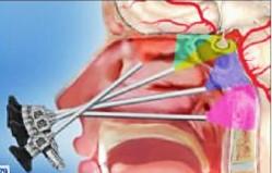 3.1.1 Die chirurgischen Zugänge Erweiterte endoskopische Zugänge ermöglichen es, Läsionen der vorderen, mittleren und hinteren Schädelgrube zu erreichen.