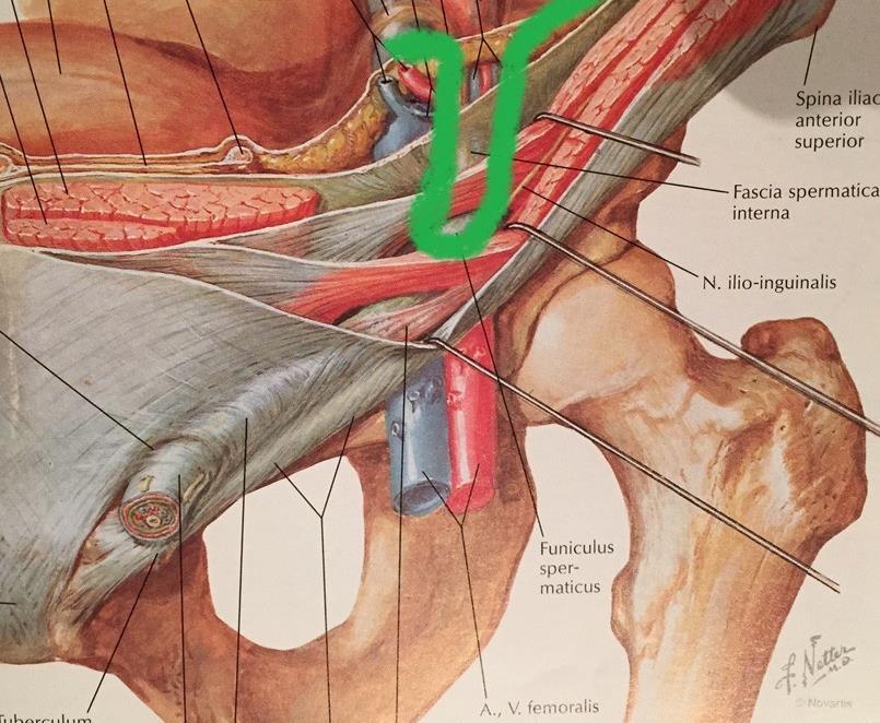 Indirekte oder laterale Inguinalhernie Leitstruktur: A./V.