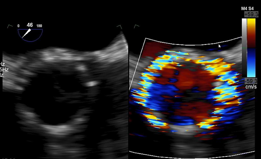 Abbildung 6: Paravalvuläre zirkuläre Aortenklappeninsuffizienz nach TAVI- Implantation in der transösophagealen Echokardiografie (aufgenommen im Klinikum der Universität München, Großhadern) Es