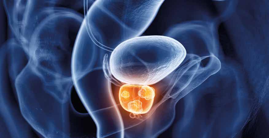 Die verschiedenen Therapiemöglichkeiten bei Prostatakrebs im Frühstadium 3D-Darstellung von Prostatakrebs im Frühstadium Grundsätzlich stehen Patienten mit örtlich begrenztem Prostatakrebs, der noch