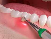 angebracht sein. Um eine Erkrankung des Zahnfleischs erfolgreich zu heilen, muss die zugrundeliegende Entzündung behandelt werden.